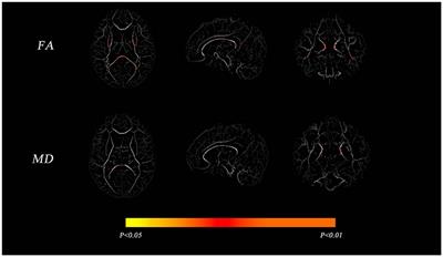 Correlation of abnormal brain changes with perinatal factors in very preterm infants based on diffusion tensor imaging